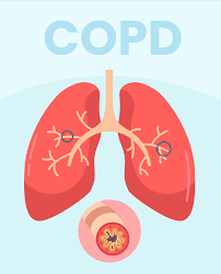 Effective Strategies for Managing COPD